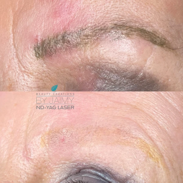 ND-Yag laser verwijderen permanent make-up